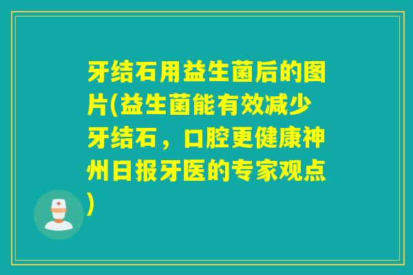 牙结石用益生菌后的图片(益生菌能有效减少牙结石，口腔更健康神州日报牙医的专家观点)